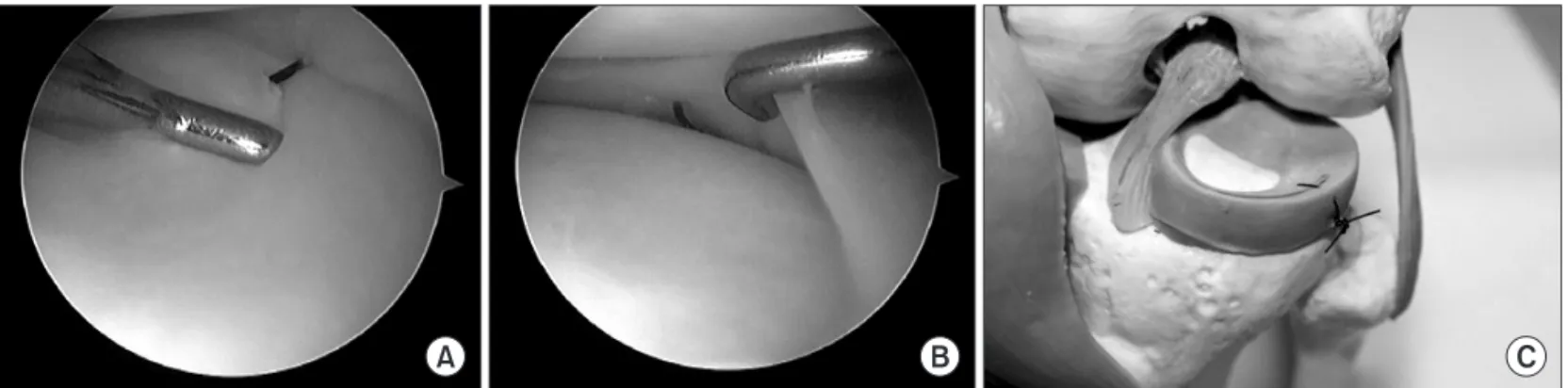 Fig. 5. (A, B) Arthroscopic views from the anterolateral portal show the suture is oriented in a vertical fashion