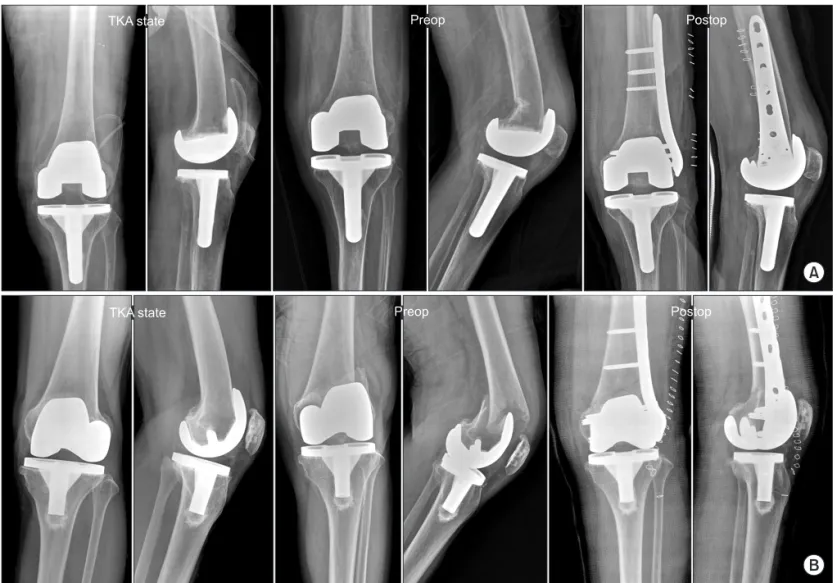 Fig. 2. (A) Radiographs obtained from a 72-year-old woman without notching after total knee arthroplasty (TKA), preoperatively (Preop), and im- im-mediately postoperatively (Postop)