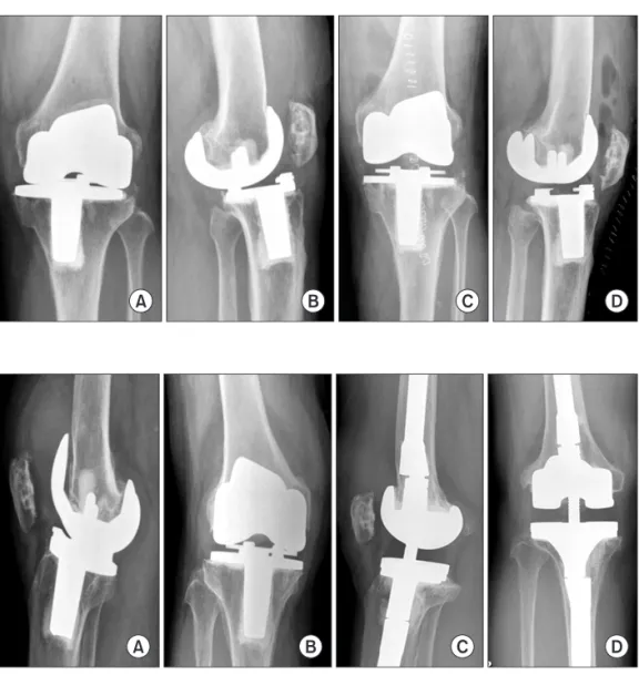 Fig. 1. (A, B) Radiographs showing failure  of total knee arthroplasty (TKA) that  oc-curred 11 years after primay TKA due to  polyethlylene wear in a 50-year-old female