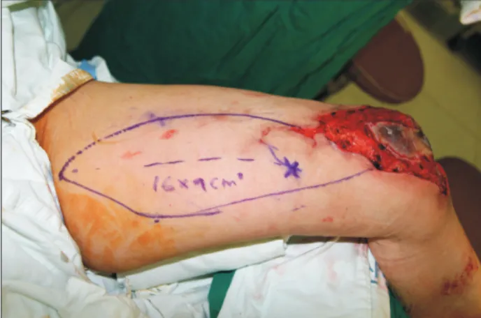 Fig. 3. A pedicled perforator flap 16×7 cm in size was elevated with one  perforator on the left knee.