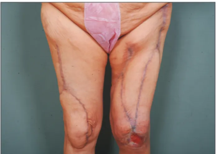 Fig. 4. Five months after placement of the pedicled perforator flap on  the left knee