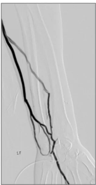 Fig. 3. Postoperative 1 month venography. Blood flow and vessel  diameter maintained the function of the arteriovenous fistula well.