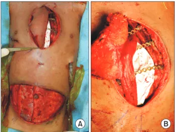 Fig. 2. The preoperative design of the transverse rectus abdominis  myocutaneous flap.