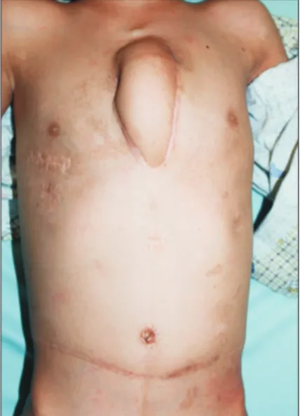 Fig. 5. A postoperative view of the patient, 14 weeks after the  reconstruction.