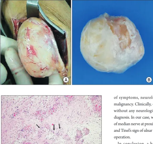 Fig. 3. A 5×4×8 cm sized well encapsul- encapsul-ated mass originencapsul-ated from median nerve  was observed during the surgery (A) and  enucleated (B).