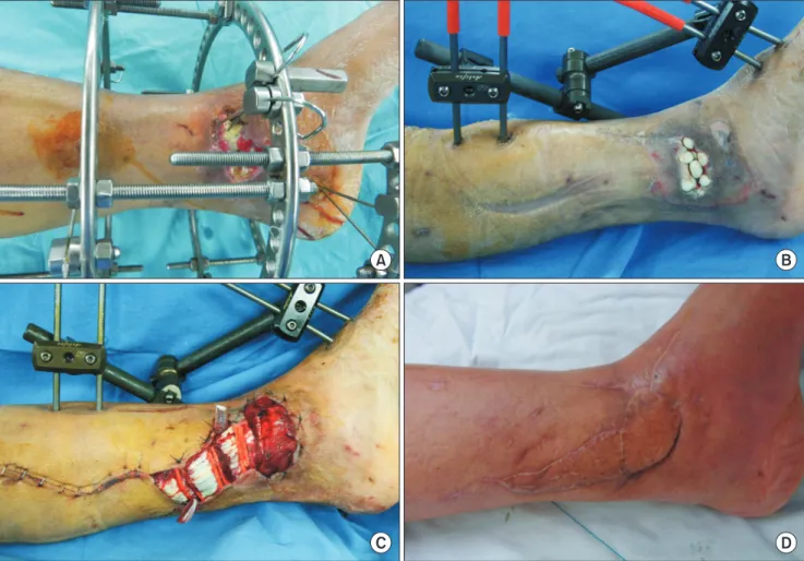 Fig. 1. A 62-year-old male patient with open comminuted intraarticular fracture of the distal tibia