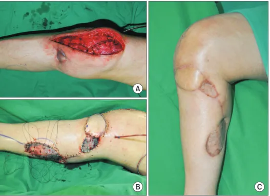 Fig. 3. Soft tissue reconstruction by reverse anterolateral thigh perforator flap of a 79-year-old female