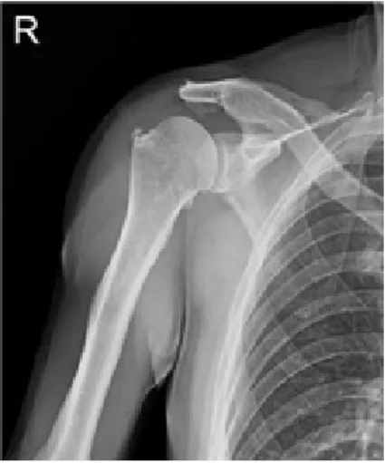 Fig.  1.  Pre-operative  X-ray  image  of  shoulder. 
