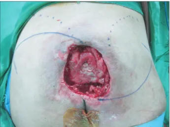 Fig. 3. Th e sutured hatchet fl ap, suffi  ciently covering the large defect.