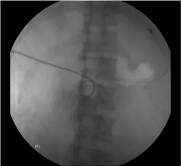 Fig. 3. Fluoroscopic finding. An 8-Fr pigtail catheter was inserted  through the right transhepatic access to the duodenal submucosal hematoma.