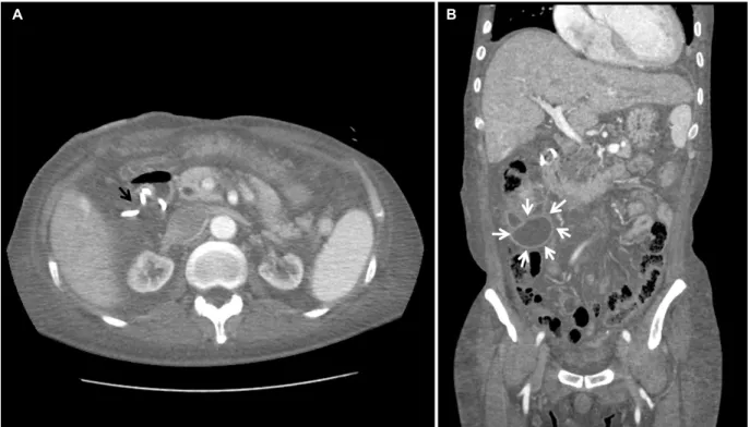 Fig. 5. After 4 weeks of catheter drainage, the follow-up abdominal computed tomography showed near resorption of the hematoma in the  submucosal area of the duodenum and decreased loculated fluid collection in the right abdomen (black arrow, resolved intr