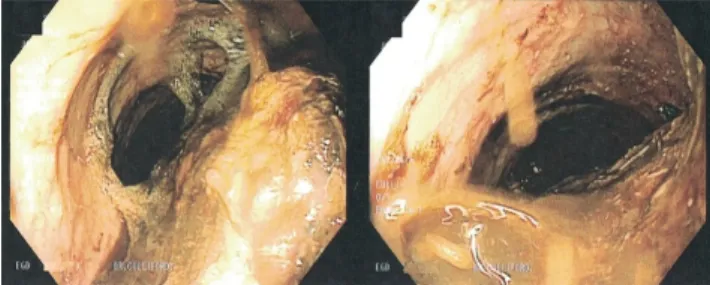 Fig. 2. CT image scan of the chest showing a dilated esophagus  resulting in compressed right main stem bronchus (arrow)  intermedius