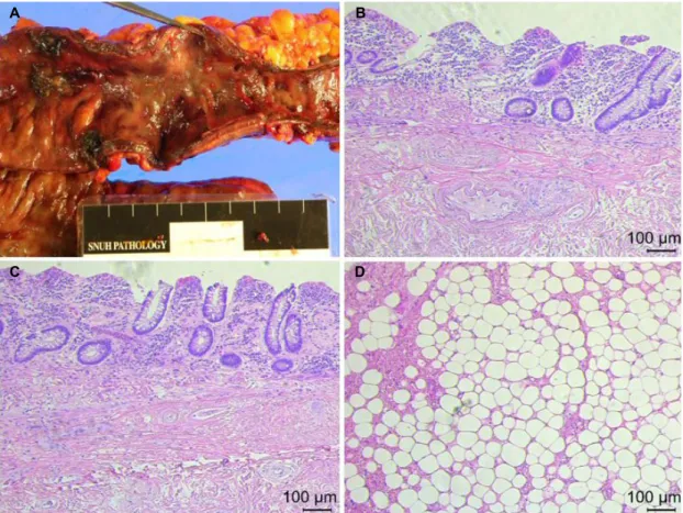 Fig. 3. Pathologic findings of biopsy specimen from the colonic  mucosa showed mucosal sloughing and hyalinized lamina propria, consistent with ischemic colitis (H&amp;E, ×50).