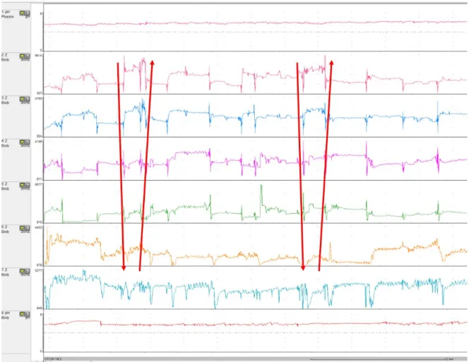 Fig. 1. Patterns of gas movement as recorded on 24-hr pH impedance testing. Air enters the proximal part of esophagus and travels downward  rapidly