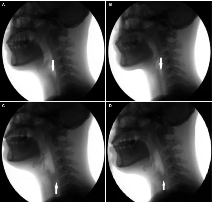 Fig. 2. Patterns of serial air flow (indicated by arrows) as recorded on videofluorescent swallowing study