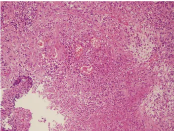 Fig. 2. Histopathological findings showing chronic active gastritis  with necrotic detritus (H&amp;E, ×100).