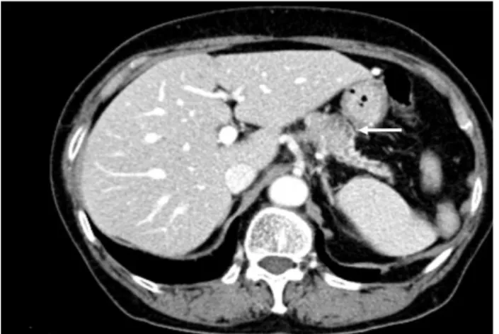 Fig. 2. Magnetic resonance T2-weighted image showing a 3.5 cm mass in the pancreatic body (white dashed arrow).