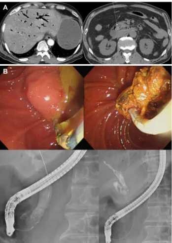 Fig. 2. Second ERCP findings. Multiple biliary strictures developed at the hilum and common hepatic duct, and endobiliary biopsy was done at the stricture site