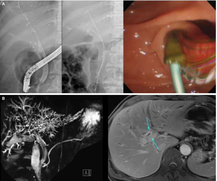 Fig. 3. (A) Third ERCP findings. Barrel-shaped biliary cast was removed with basket catheter