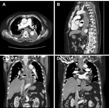 Fig. 1. Initial chest CT. CT scans with axial (A), sagittal (B) and coronal (C, D) images show diffuse wall thickening with intramural low density (arrows) from esophagus to gastric cardia