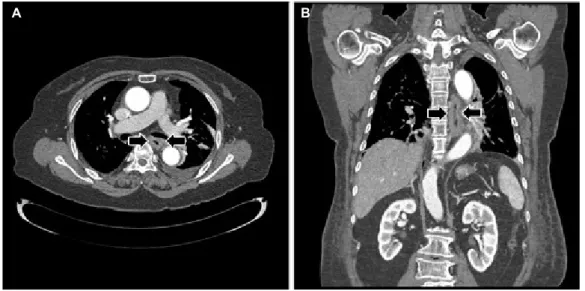 Fig. 2. Follow-up chest CT (3 weeks after medical therapy). CT scans with axial (A) and coronal (B) images reveal the improvement of diffuse  wall thickening (arrows) from esophagus to gastric cardia