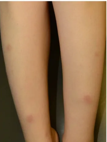 Fig. 1. Erythema nodosum. Tender, bilateral, erythematous nodules and plaques on the anterior aspect of the lower extremities.