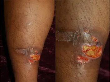 Fig. 2. Pyoderma gangrenosum. Ulcer shows an edematous pale  border with granulation tissue on the leg.