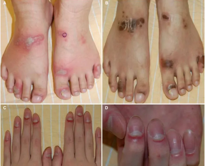 Fig. 4.  Acrodermatitis enteropathica. (A) Multiple flaccid bullae and vesicles on dorsum of the feet