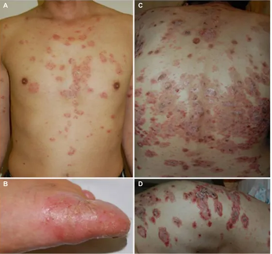 Fig. 5. TNF-α inhibitor treatment-induced skin manifestations. (A, B) Small plaque psoriasiform lesions scattered over the trunk and  palmoplantar pustular psoriasiform lesions following TNF-α inhibitor therapy