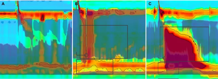 Fig. 1. Achalasia subtypes according to Chicago classification in high resolution manometry
