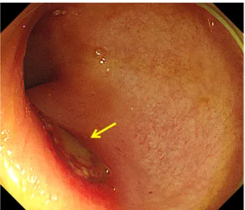 Fig. 2. Sigmoidoscopic examination showing a fairly well-marginated ulcer lesion (arrow) without an ischemic background.