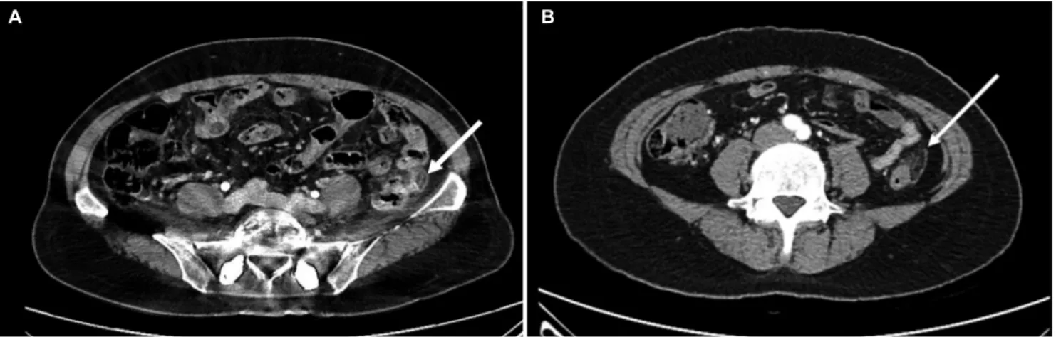 Fig. 2. Contrast enhanced computed tomography scan cases of epiploic appendagitis. (A) A 42 years old female admit the emergency room  with left lower quadrant pain for 5 days, the axial view showed the rim enhanced fat infiltration adjacent descending col