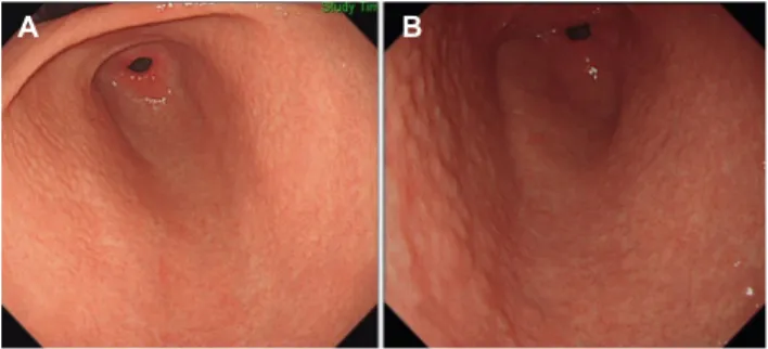 Fig. 1. Two main subtypes of nodular gastritis. (A) Small-granular-type nodular gastritis consisting of multiple 1-2 mm subepithelial nodules in the antrum