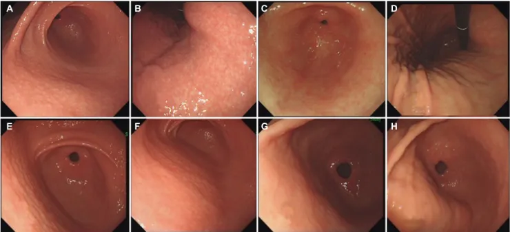 Fig. 4. Different prognosis of small-granular-type nodular gastritis according to the presence of a H
