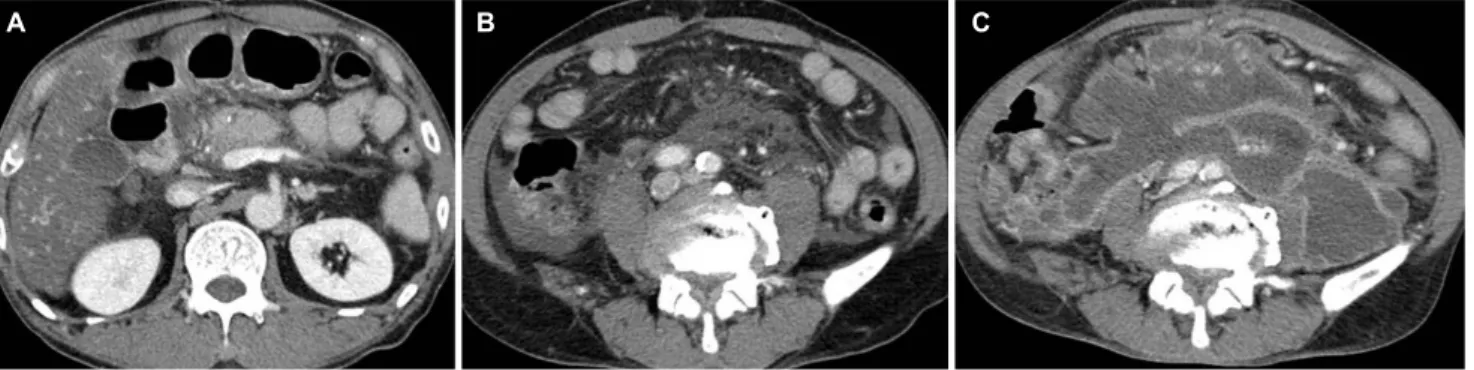 Fig. 1. Computed tomography (CT) scans of the patient. Initial CT scan reveals edematous change of the pancreatic head with acute  peripancreatic fluid collection (A) extending to the pelvic cavity (B)