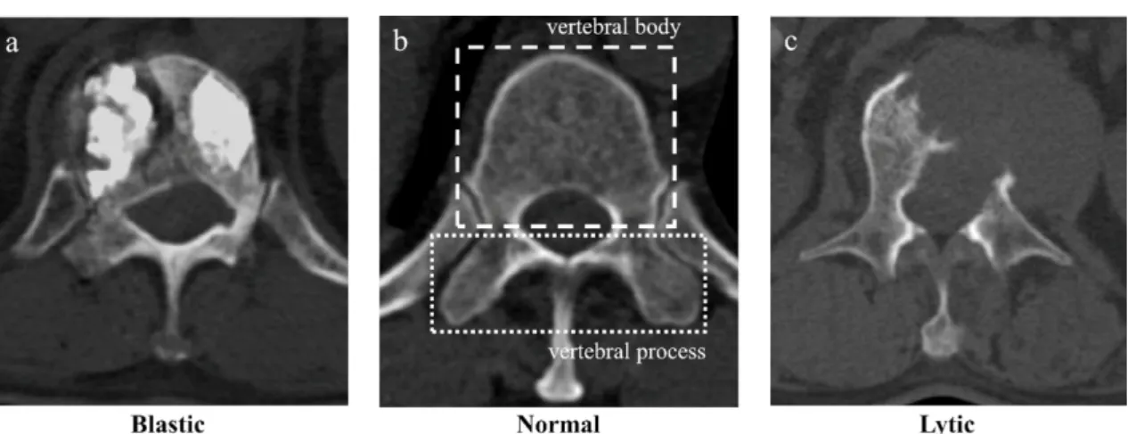 Fig. 1. From the left, the blastic(a), normal(b), and lytic(c) spinal metastases were presented