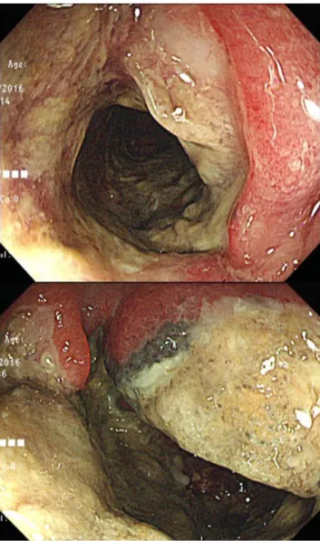 Fig. 2. Colonoscopy shows a huge ulcerative mass with luminal  narrowing at hepatic flexure.
