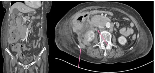 Fig. 5. Pathological findings of the tumor revealed sheets of atypical large pleomorphic lymphoid cells with prominent nucleoli and  apoptotic bodies (A; H&amp;E, ×400) with pan-B cell marker expression (B; CD20, ×100).