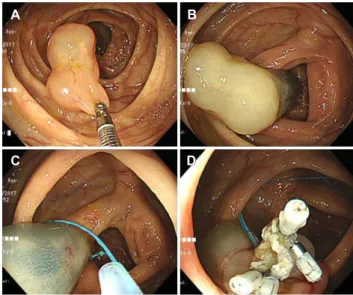 Fig. 1. Colonoscopic findings. (A) A 3 cm-sized, bluish-red polypoid  mass was noted at the ileocecal valve