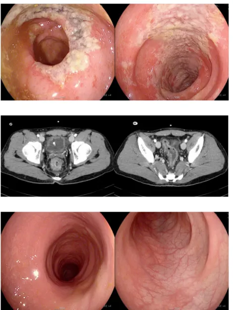 Fig. 1. Sigmoidoscopy taken on the second day of  hospitalization revealed necrosis in the rectum and rectosigmoid junctional colonic mucosa.
