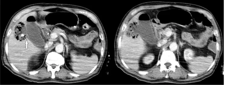 Fig. 1. Initial computed tomography scan showed acute calculous cholecystitis accompanied by focal perforation (arrow) and a 6×3.8 cm sized liver abscess and gallstone outside gallbladder.