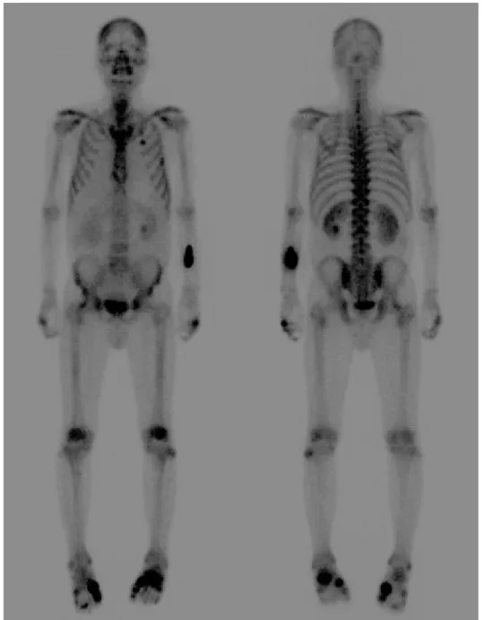 Fig. 6. Technetium-99m hydroxymethylene diphosphonate bone scan showing symmetrical uptake in the foot, hand, wrist, and elbow joints.