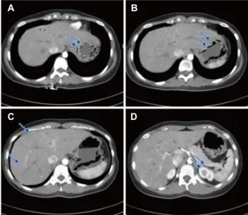 Fig. 1. (A, B) Air density in the thickened wall of the high body of the stomach (arrows)