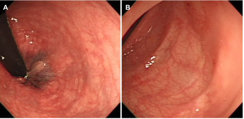 Fig. 3. Follow-up endoscopic findings. Improvement of the previous endoscopic abnormalities at the rectum (A) and sigmoid colon (B) after steroid  treatment.이  보였다(Fig