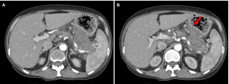 Fig. 1. (A) Contrast-enhanced CT image shows an 8.4×4 cm sized pancreatic pseudocyst adjacent to the posterior wall side of the stomach.