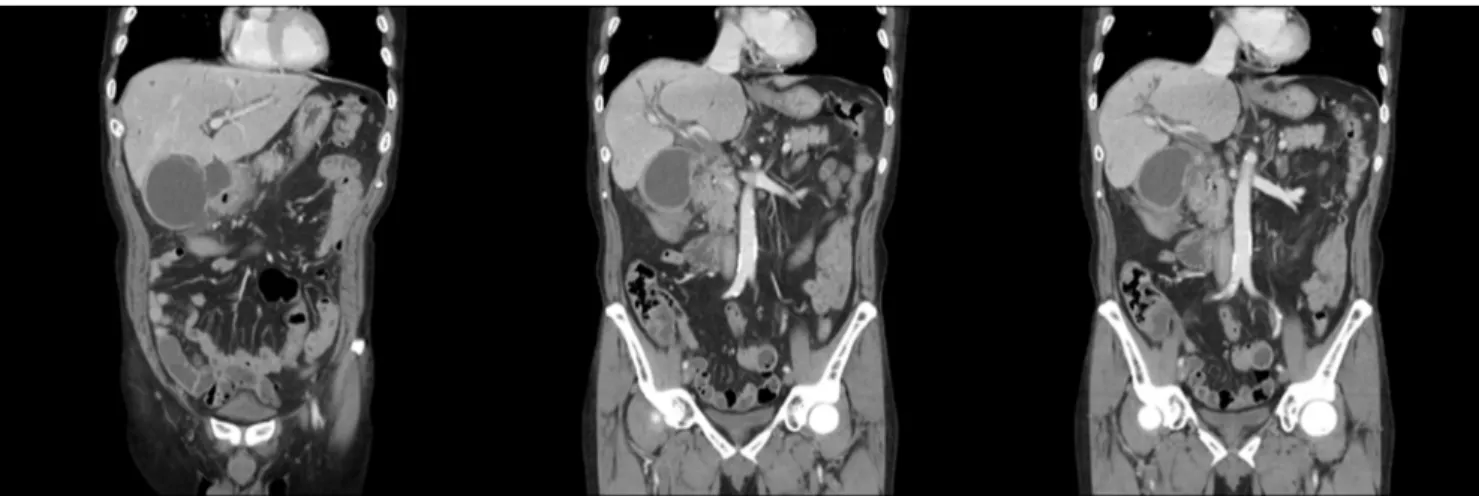 Fig. 1. Abdominal computed tomography scan showed a perforated gallbladder and abscesses at lesser sac and ligament teres, which is  suspicious for acute perforated cholecystitis, diffusely thickened common bile duct and intrahepatic duct dilatation with a