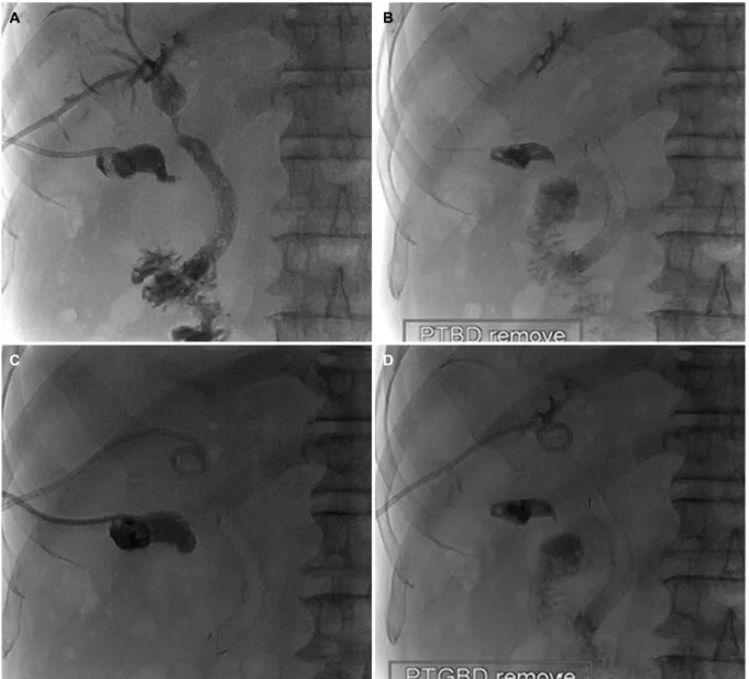 Fig. 3. (A-D) PTBD was removed successfully after endobiliary radiofrequency ablation followed by biliary stent placement