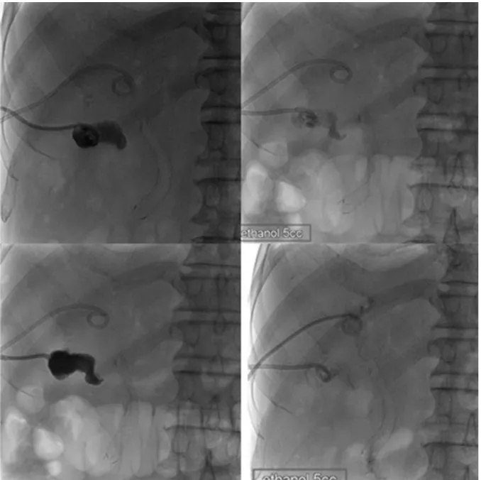 Fig. 4. Two cycles of chemical ablation of the gallbladder using 5 mL of pure ethanol at one-week intervals were performed to remove  percutaneous transhepatic gallbladder drainage catheter.