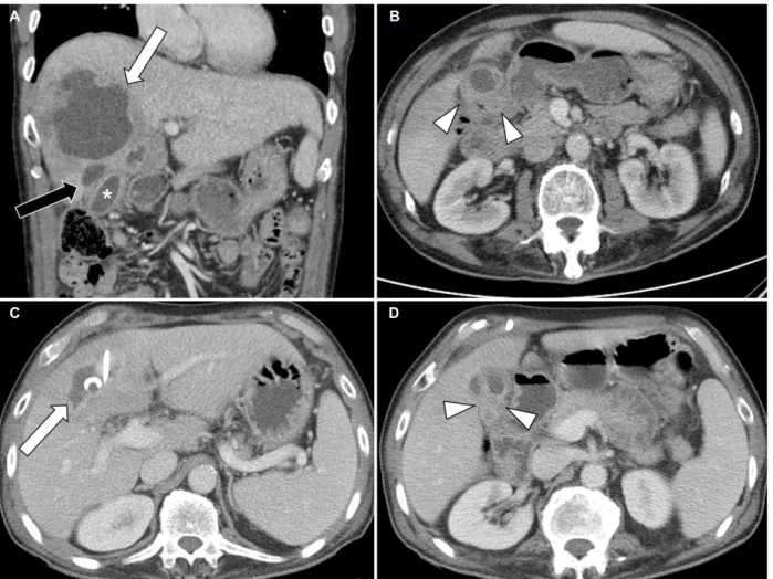 Fig. 1. Initial abdomen pelvic computed tomography. (A) About a 9.3 cm irregular rim enhancing lesion (arrows) was seen in segment 4 of  the liver