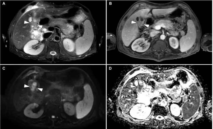 Fig. 2. Gallbladder magnetic resonance imaging. (A) Wall thickening (arrowheads) with annular narrowing was seen in the body on the  T2-weighted image